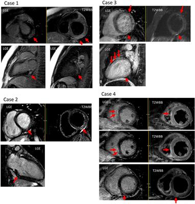 Case Report: Importance of MRI Examination in the Diagnosis and Evaluation of COVID-19 mRNA Vaccination Induced Myocarditis: Our Experience and Literature Review